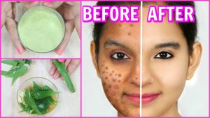Successful Home Remedies To Remove Pimples Naturally and Permanently 