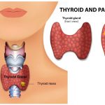 Everything you need to know about Thyroid Disease